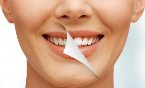 Sbiancamento dei denti: tutto quello che c’è da sapere